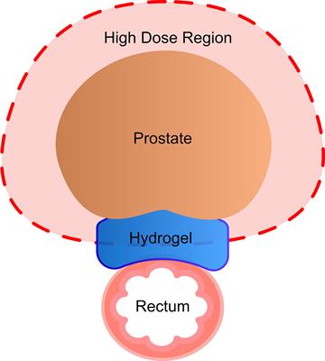 Rectal Radiation Dose and Clinical Outcomes in Prostate Cancer Patients Treated With Stereotactic Body Radiation Therapy With and Without Hydrogel